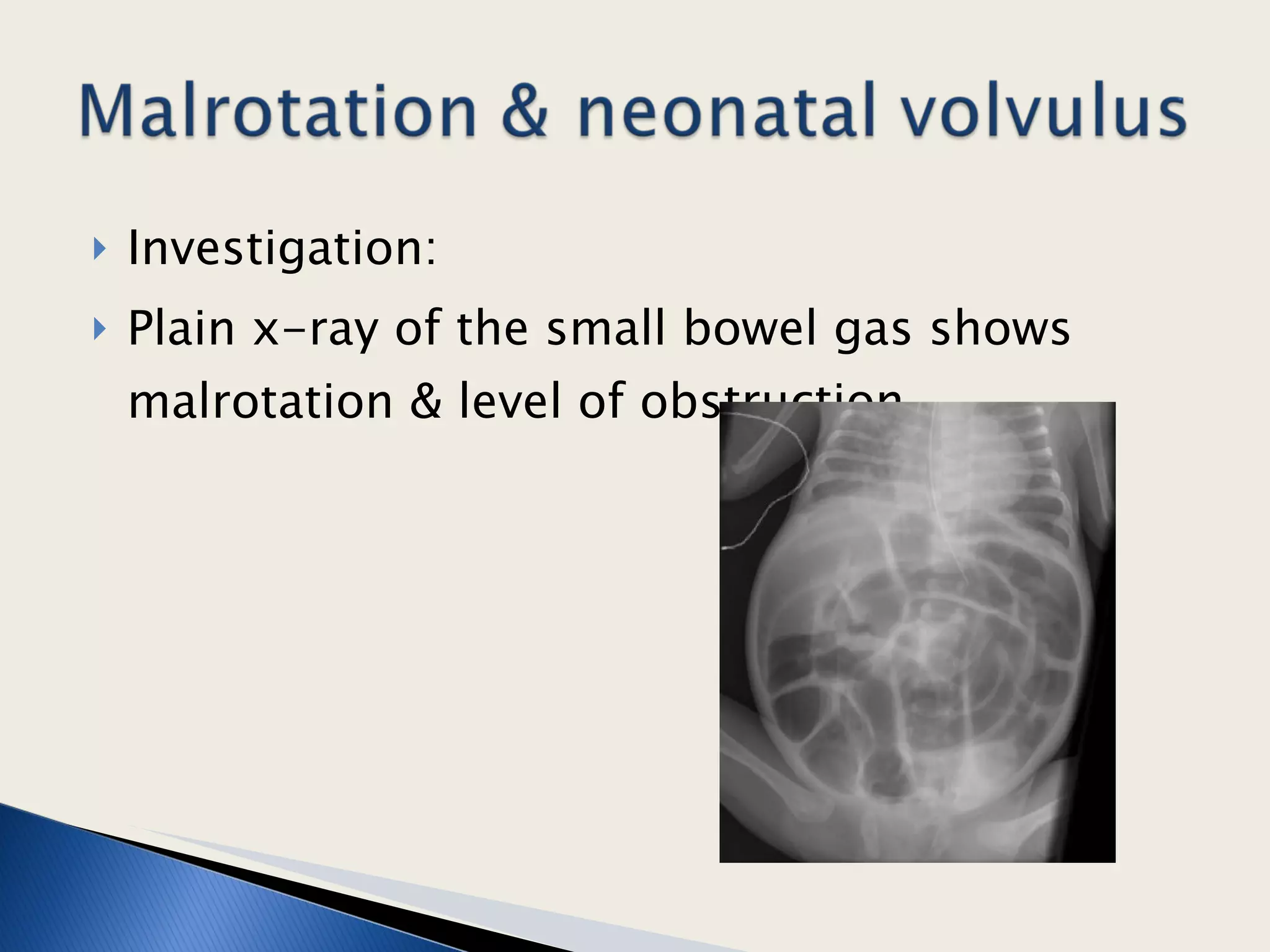 Investigation: Plain x-ray of the small bowel gas shows malrotation & level of obstruction.  
