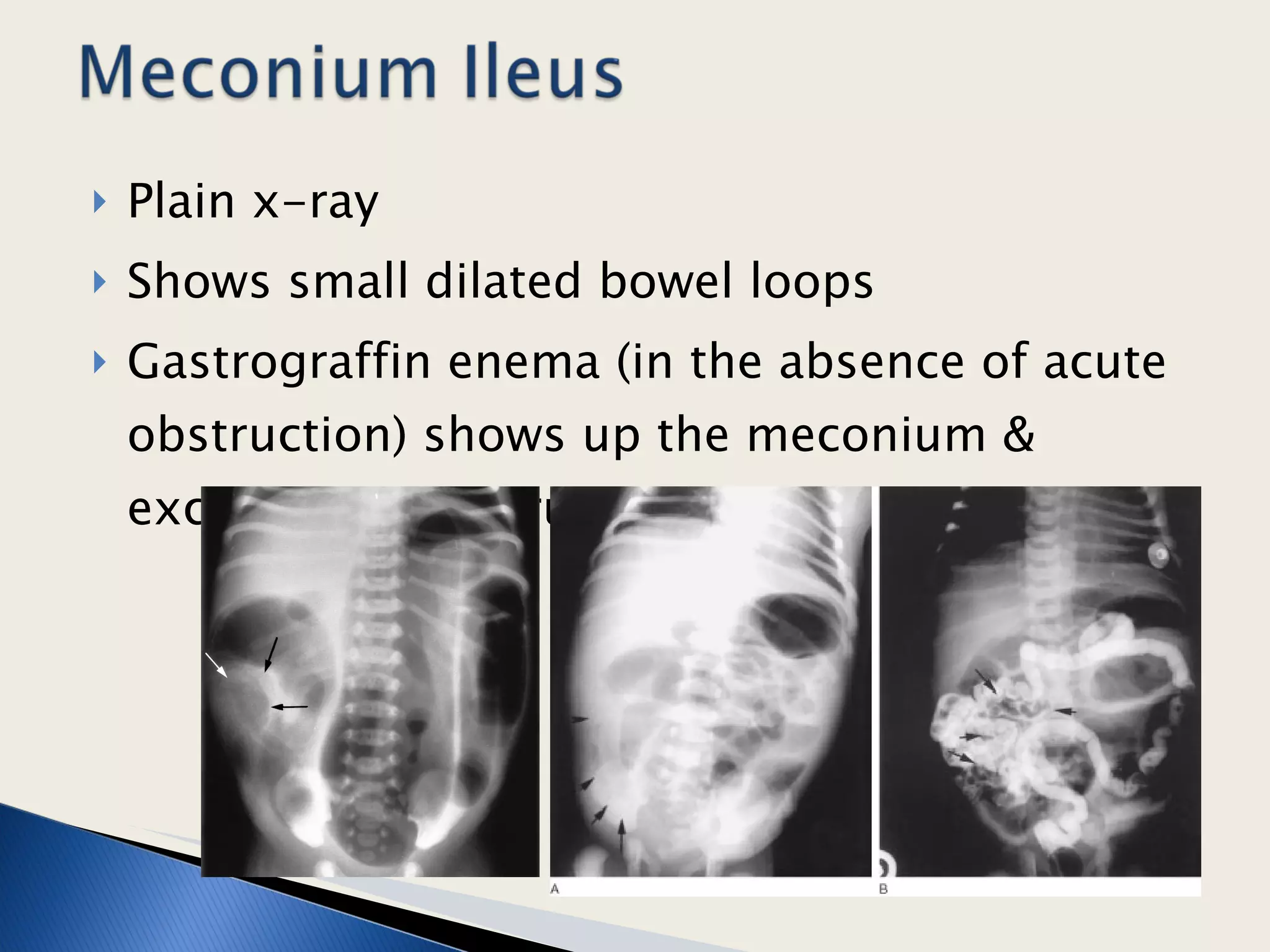 Plain x-ray Shows small dilated bowel loops Gastrograffin enema (in the absence of acute obstruction) shows up the meconium & excludes Hirshsprung’s disease.  