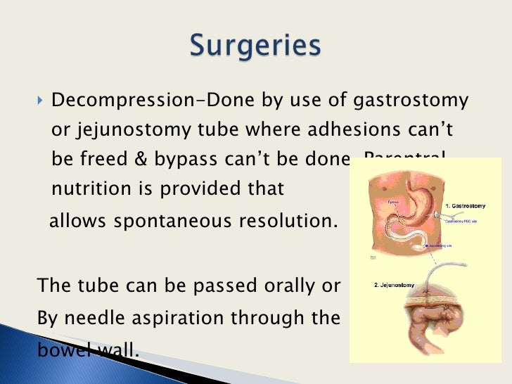 Management Of Intestinal Obstruction