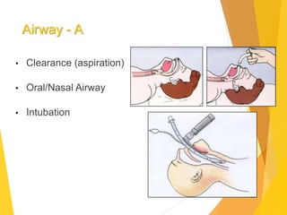 Airway - A
• Clearance (aspiration)
• Oral/Nasal Airway
• Intubation
 