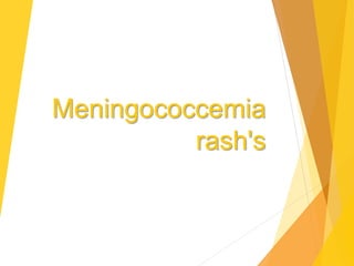 Meningococcemia
rash's
 