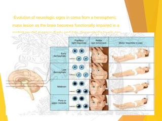 Evolution of neurologic signs in coma from a hemispheric
mass lesion as the brain becomes functionally impaired in a
rostral caudal manner. Early and late diencephalic levels are
levels of dysfunction just above (early) and just below (late)
the thalamus.
 