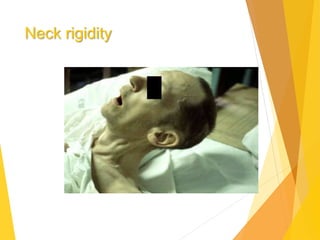 Neck rigidity
 
