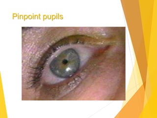 Pinpoint pupils
 