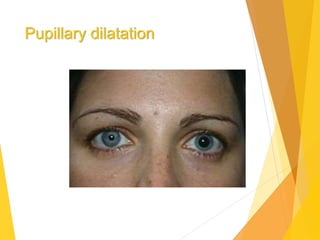 Pupillary dilatation
 