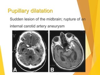 Pupillary dilatation
Sudden lesion of the midbrain; rupture of an
internal carotid artery aneurysm
 