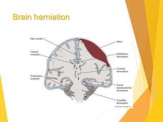 Brain herniation
 