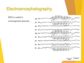 Electroencephalography
EEG is useful in
unrecognized seizures.
 