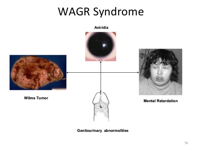 wagr syndrome In a report of a cohort of 61 patients with wagr syndrome, the oldest patient in whom wilms tumor developed was aged 7 years 3 months. wagr syndrome In a report of a cohort of 61 patients with wagr syndrome, the oldest patient in whom wilms tumor developed was aged 7 years 3 months.