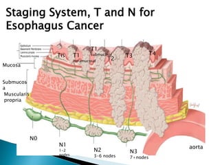 Staging System, T and N for
Esophagus Cancer
Tis T1
intramucosal
T1
submucosal
aorta
T4T3
T2
N0
N1
1-2
nodes
Mucosa
N2
3-6 nodes
N3
7+nodes
Muscularis
propria
Submucos
a
 