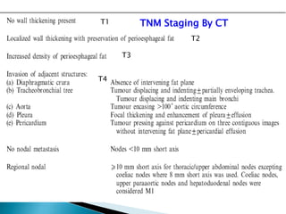T1
T2
T3
TNM Staging By CT
T4
 