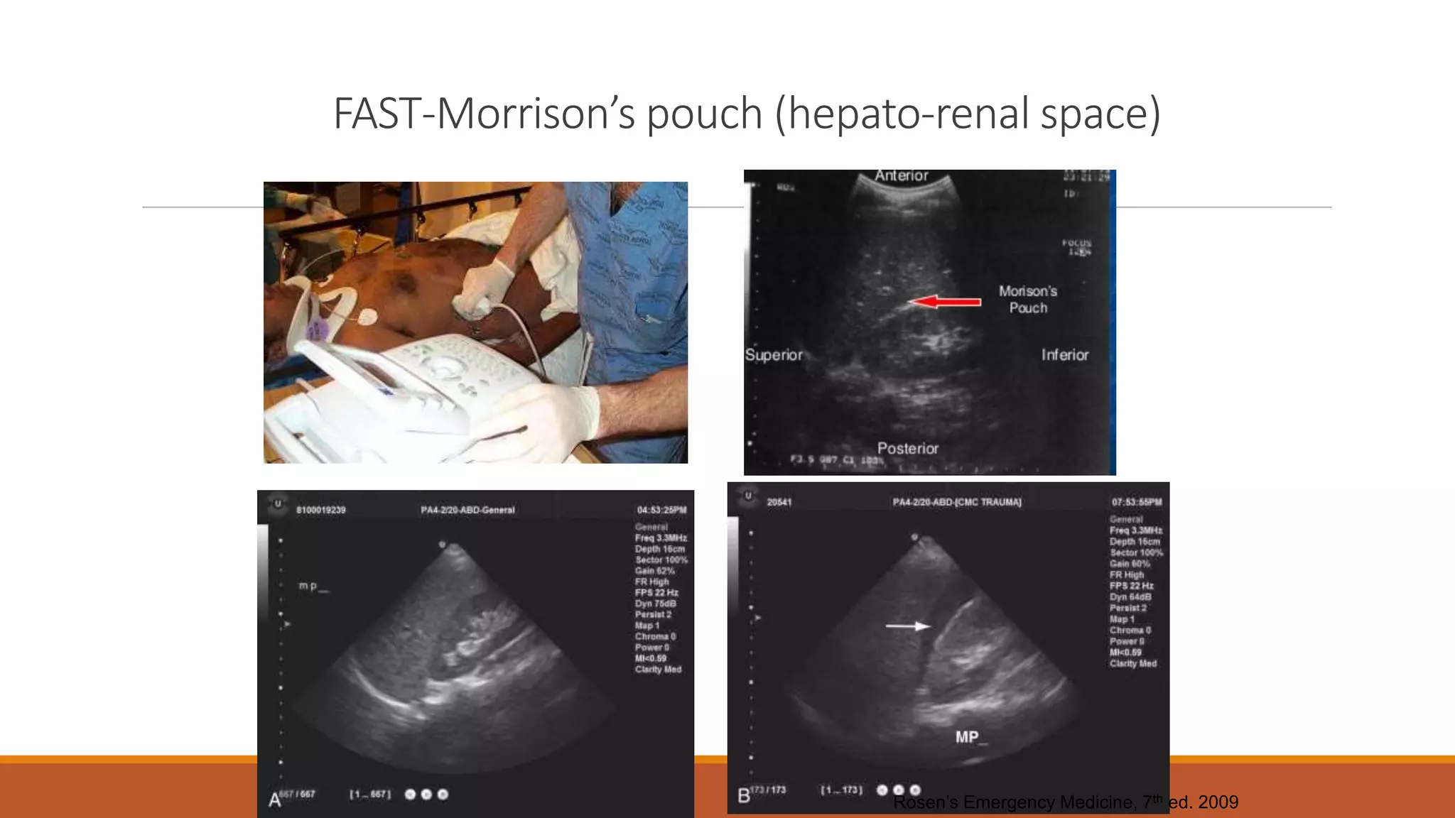FAST-Morrison’s pouch (hepato-renal space)
Rosen’s Emergency Medicine, 7th ed. 2009
 