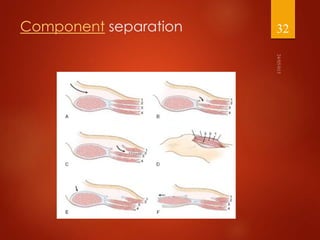 Management of abdominal wall defects | PPTX