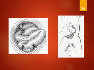 Management of abdominal wall defects | PPTX