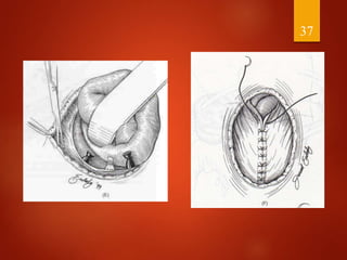 Management of abdominal wall defects | PPTX