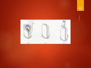 Management of abdominal wall defects | PPTX