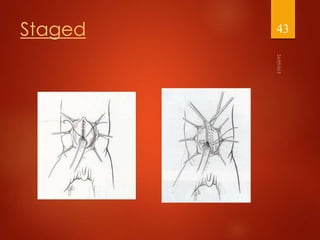 Management of abdominal wall defects | PPTX