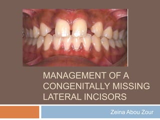 MANAGEMENT OF A
CONGENITALLY MISSING
LATERAL INCISORS
            Zeina Abou Zour
 