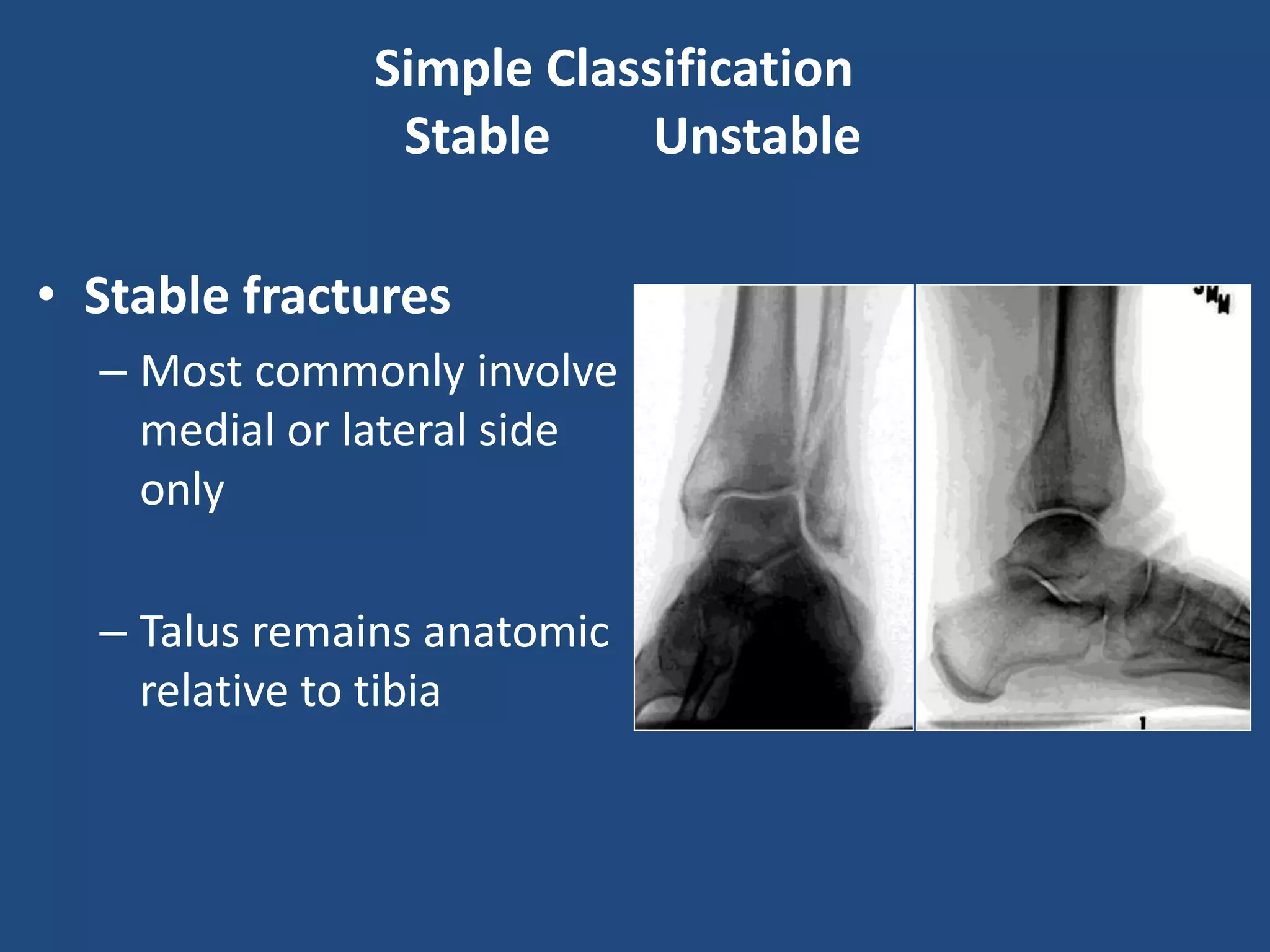 Management of acute ankle fractures | PPTX