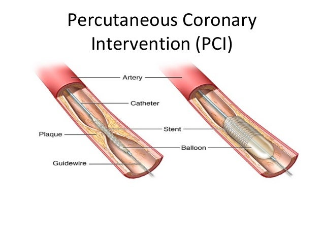 Management Of Acute Coronary Syndrome