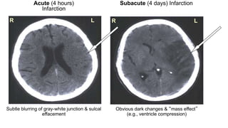 Management of acute ischemic stroke including tia [autosaved] | PPTX