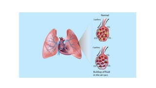Management of acute pulmonary edema | PDF