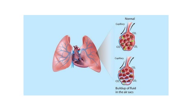 Management of acute pulmonary edema | PDF