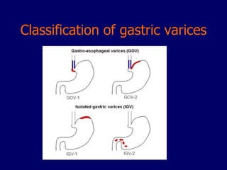 Jsph Varices Classification Management of acute upper GI hemorrhage | PPTX