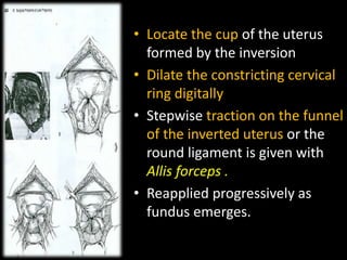 MANAGEMENT OF ACUTE UTERINE INVERSION BY DR SHASHWAT JANI | PPTX