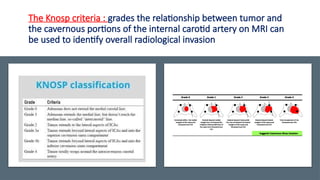 Management of Aggressive Pituitary Tumors .pptx