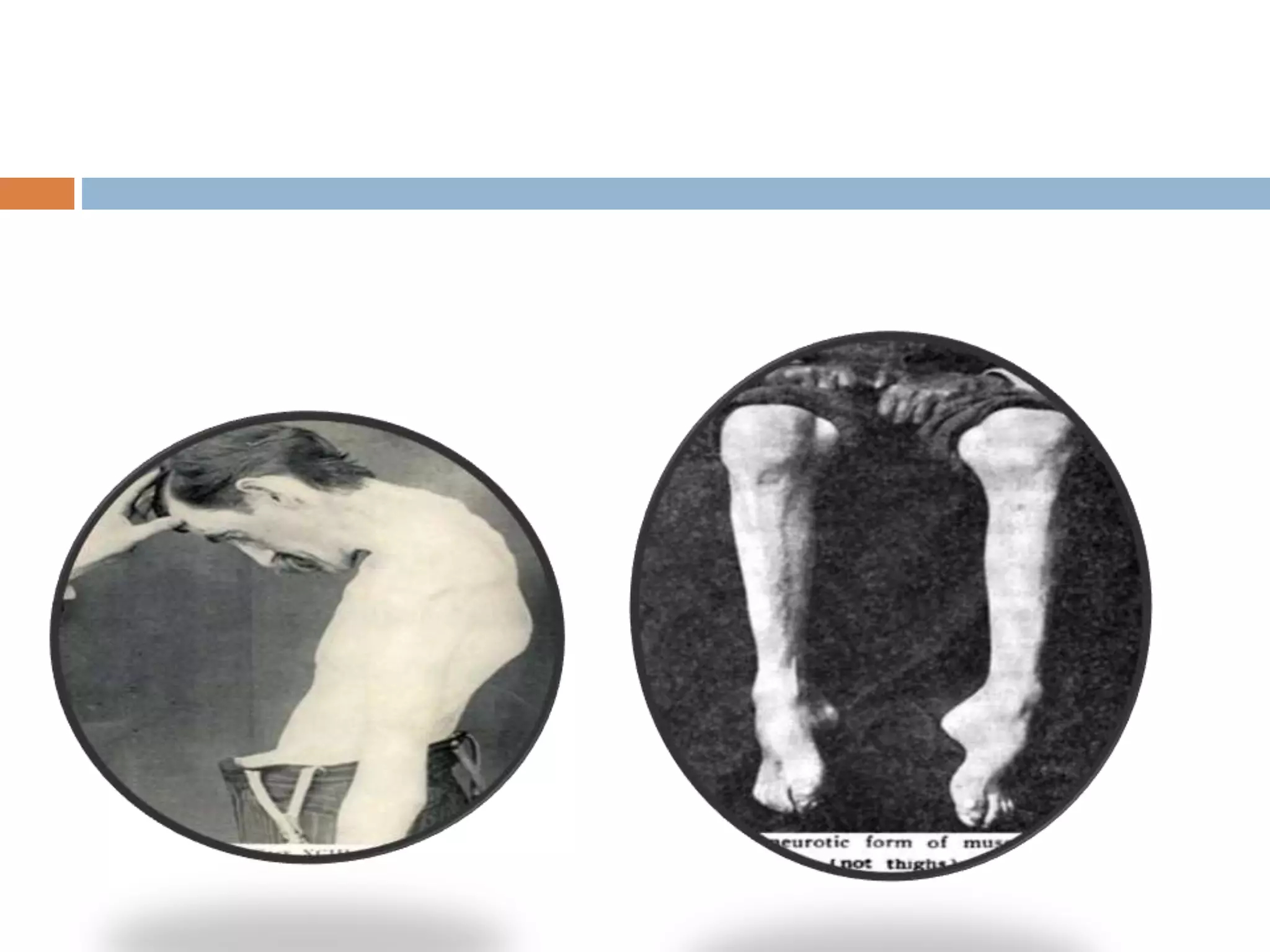 Management of ALS.pptx