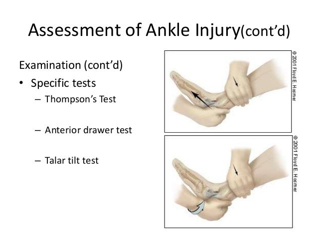 Management Of Ankle Injuries