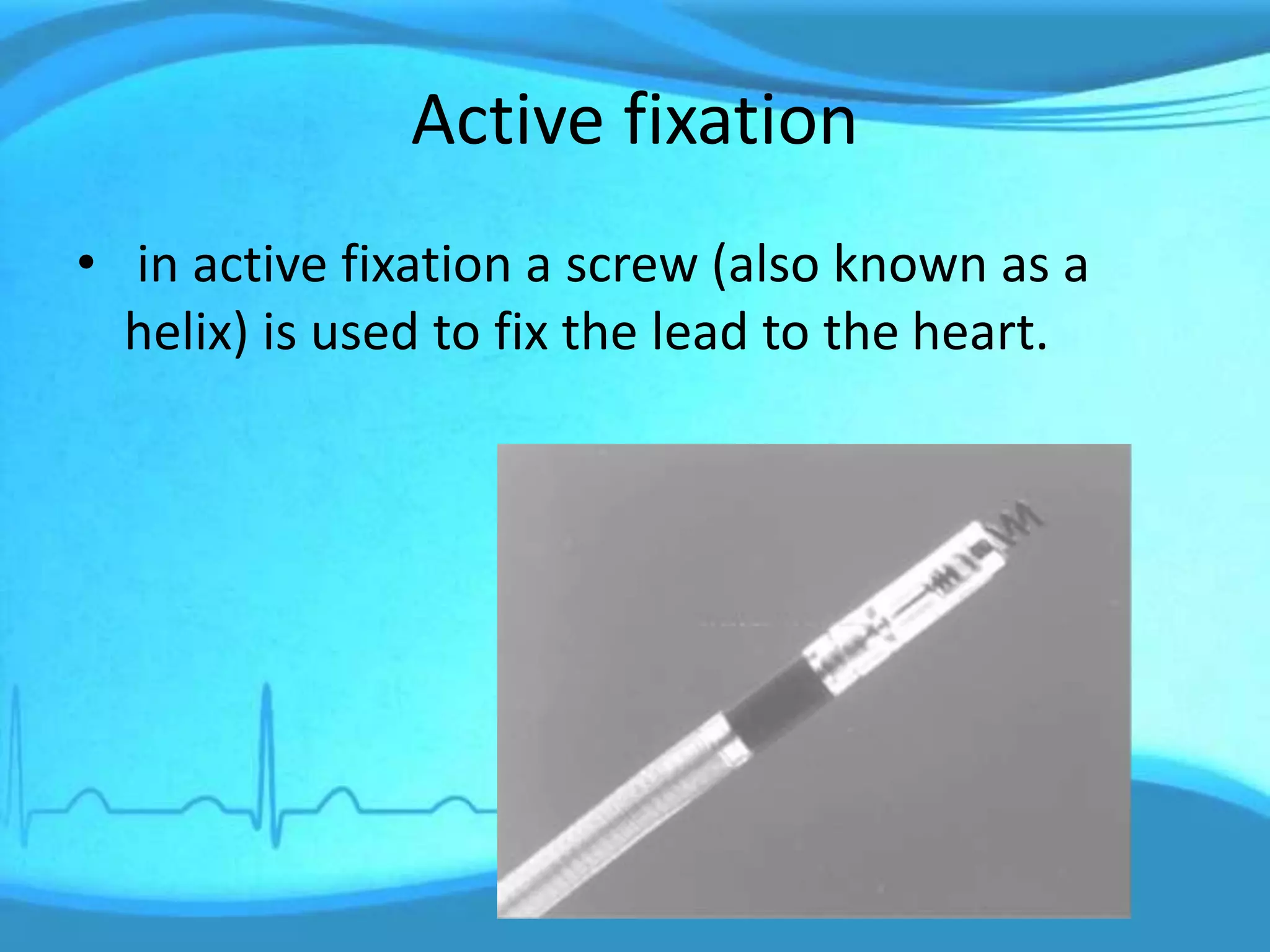 Active fixation
• in active fixation a screw (also known as a
helix) is used to fix the lead to the heart.
 