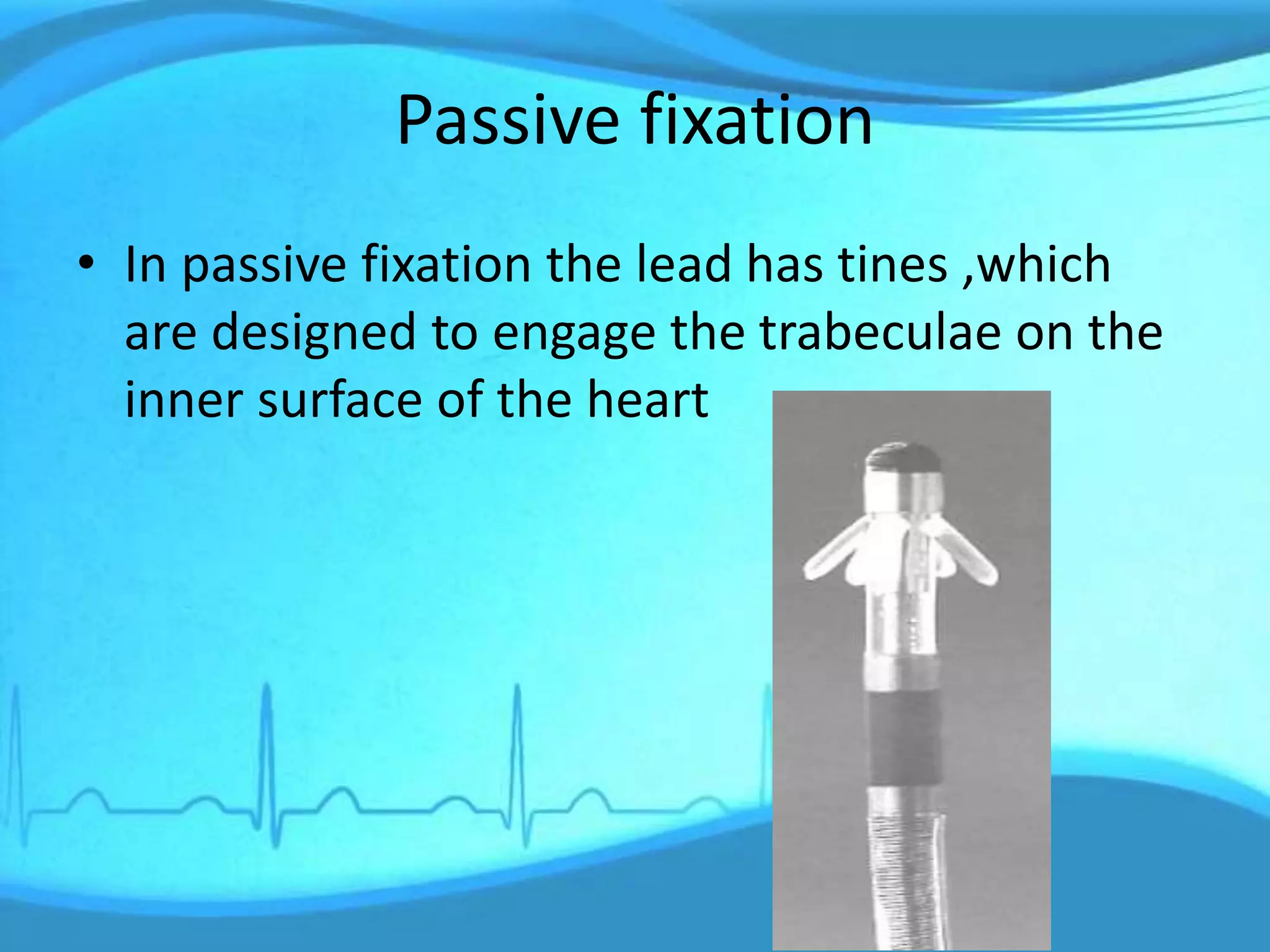 Passive fixation
• In passive fixation the lead has tines ,which
are designed to engage the trabeculae on the
inner surface of the heart
 