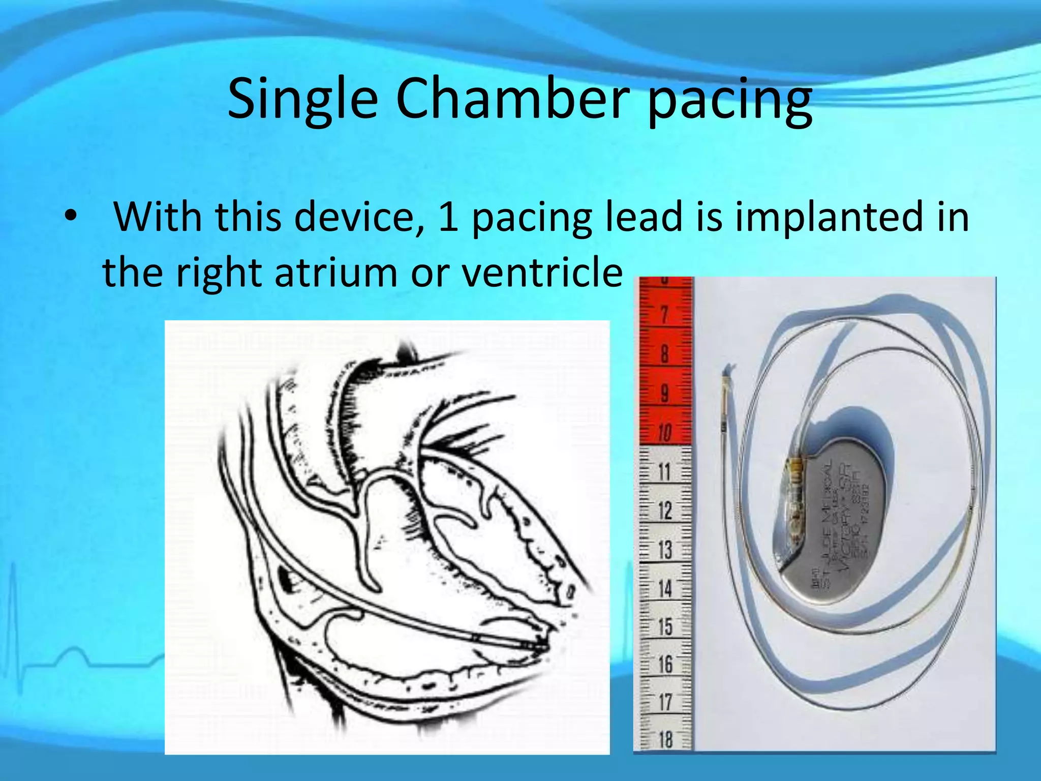 Single Chamber pacing
• With this device, 1 pacing lead is implanted in
the right atrium or ventricle
 