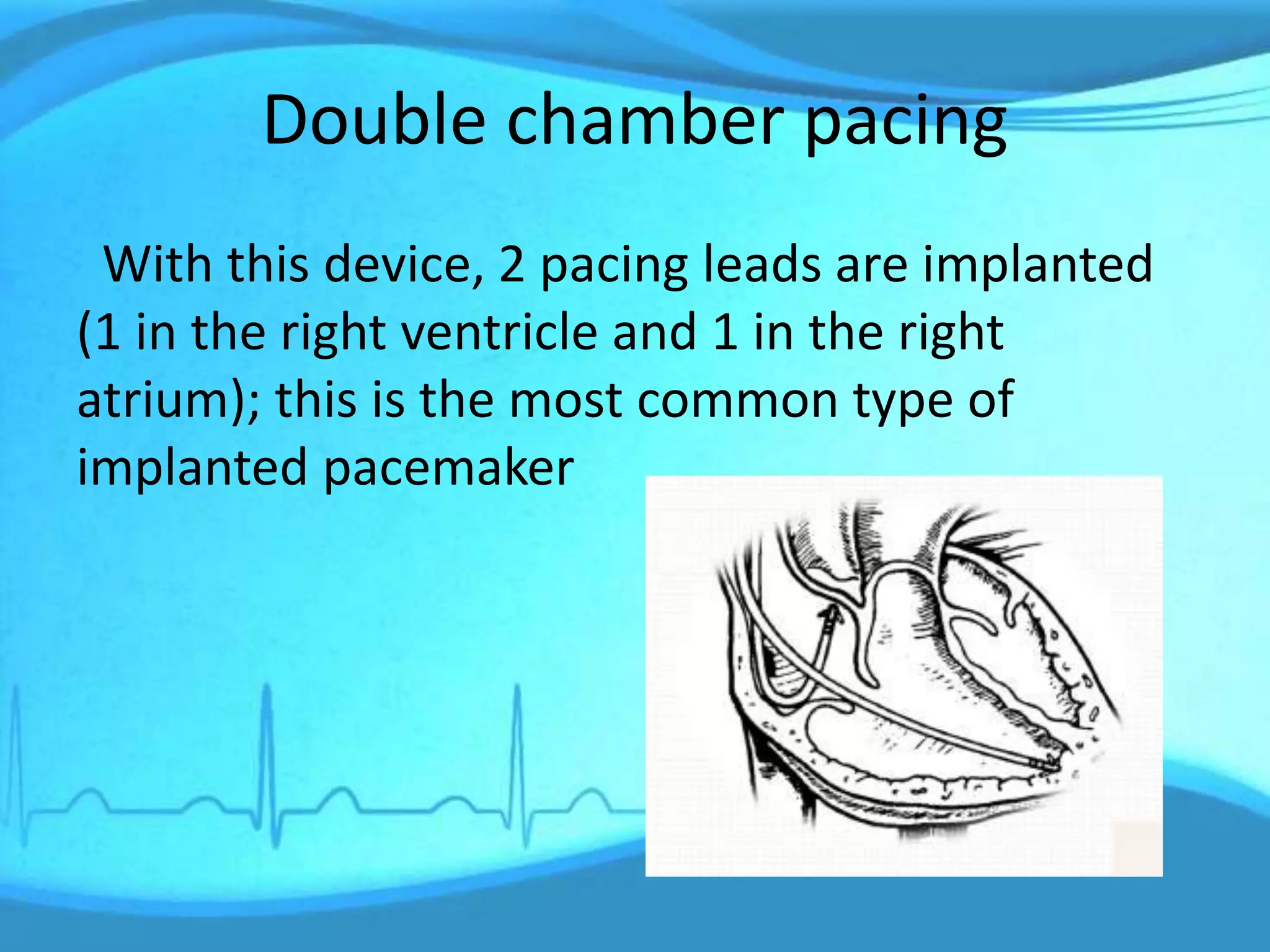 Double chamber pacing
With this device, 2 pacing leads are implanted
(1 in the right ventricle and 1 in the right
atrium); this is the most common type of
implanted pacemaker
 