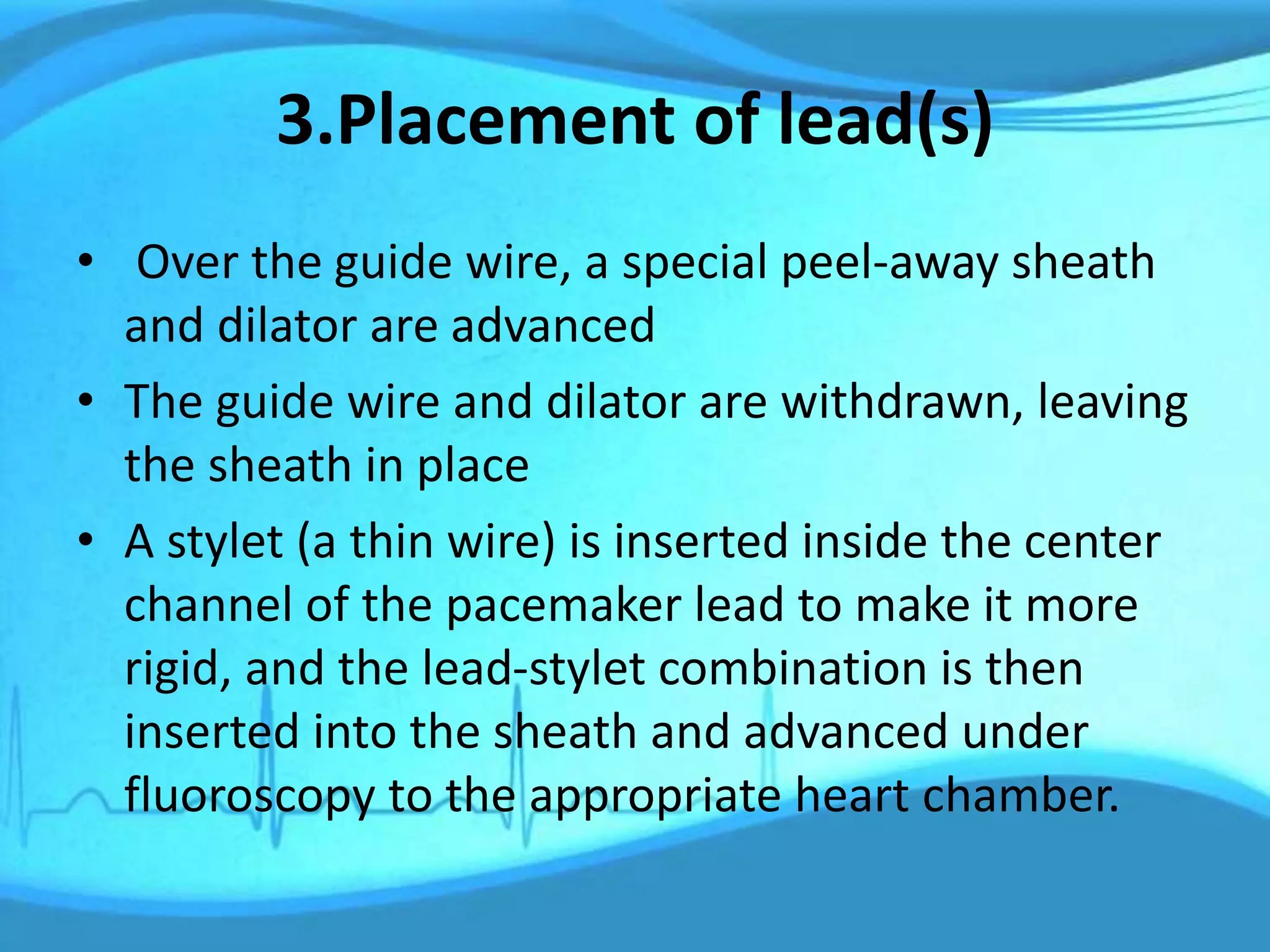 3.Placement of lead(s)
• Over the guide wire, a special peel-away sheath
and dilator are advanced
• The guide wire and dilator are withdrawn, leaving
the sheath in place
• A stylet (a thin wire) is inserted inside the center
channel of the pacemaker lead to make it more
rigid, and the lead-stylet combination is then
inserted into the sheath and advanced under
fluoroscopy to the appropriate heart chamber.
 