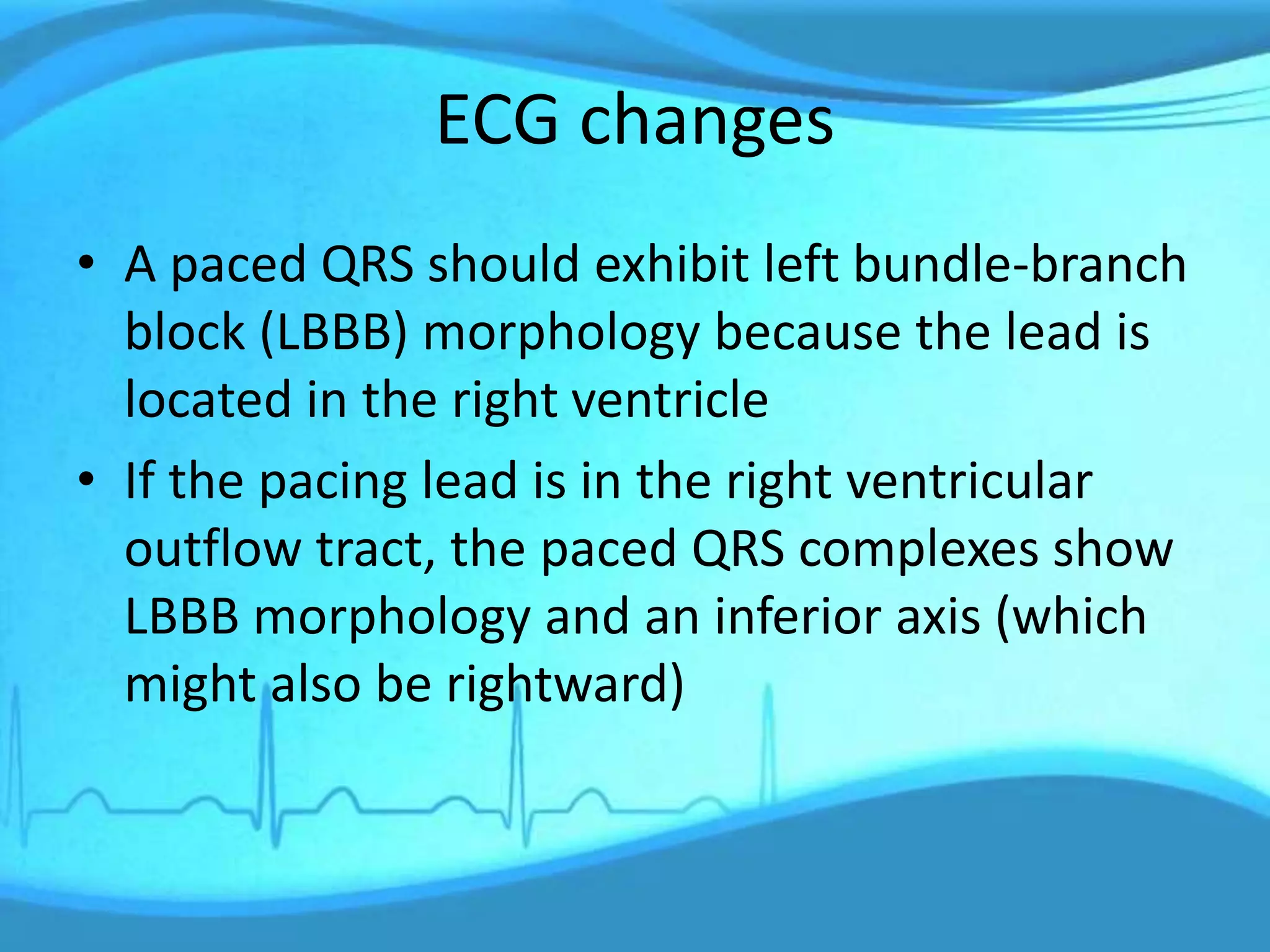 ECG changes
• A paced QRS should exhibit left bundle-branch
block (LBBB) morphology because the lead is
located in the right ventricle
• If the pacing lead is in the right ventricular
outflow tract, the paced QRS complexes show
LBBB morphology and an inferior axis (which
might also be rightward)
 