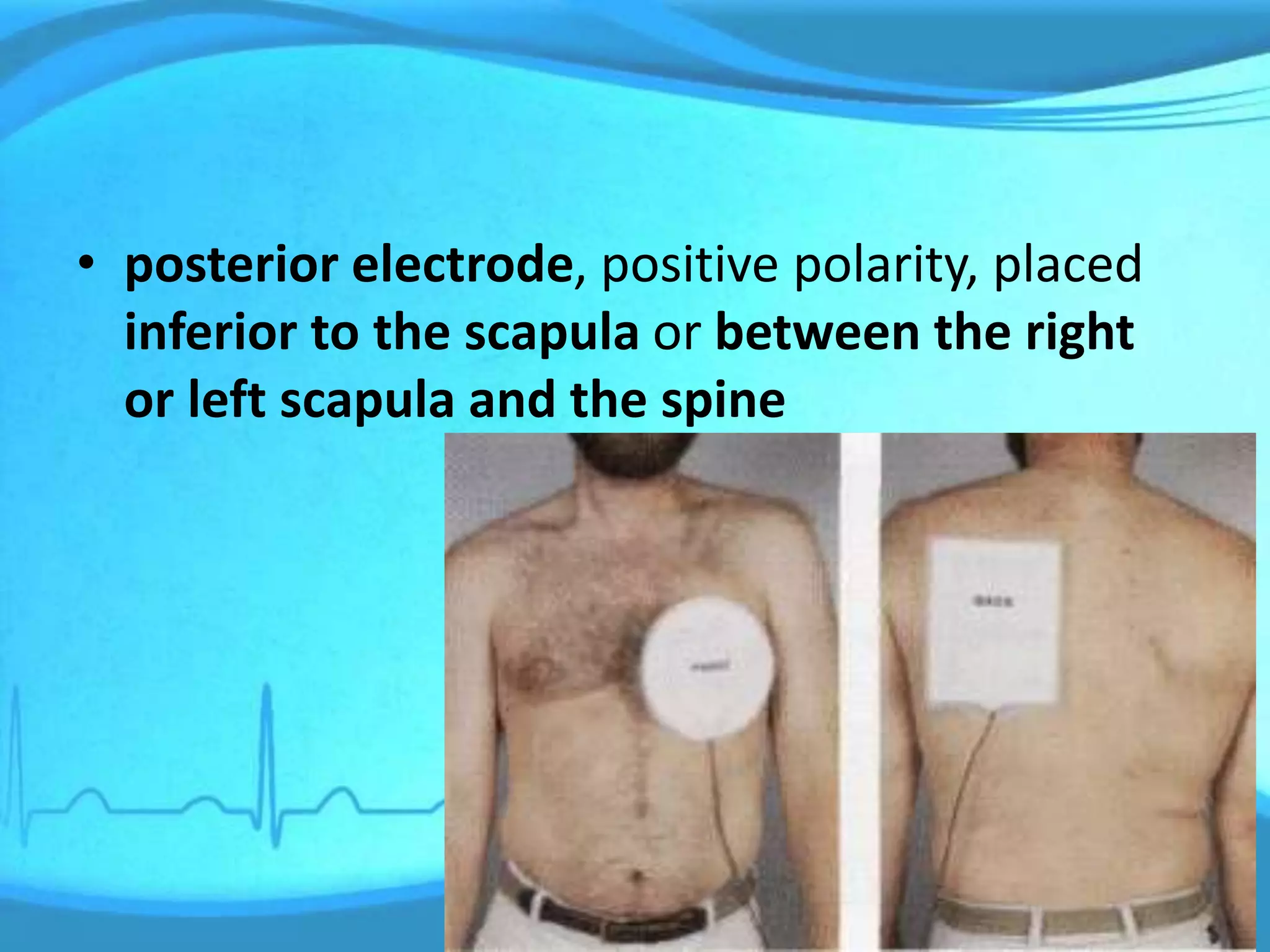 • posterior electrode, positive polarity, placed
inferior to the scapula or between the right
or left scapula and the spine
 