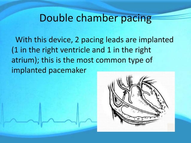 Management of a patient with pacemaker | PPTX