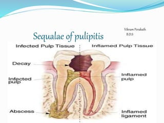 Sequalae of pulipitis 
Vikram Perakath 
B.D.S 
 
