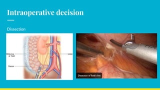 Intraoperative decision
Dissection
 