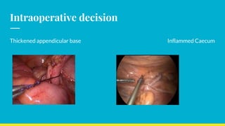 Intraoperative decision
Thickened appendicular base Inflammed Caecum
 