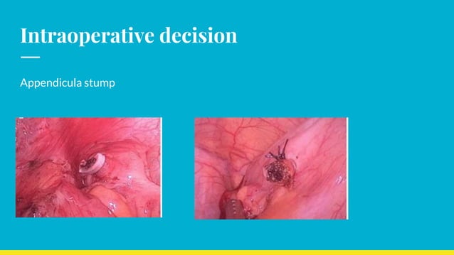 Management of Appendicular Lump | PPTX | Digestive Disorders | Diseases ...