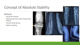 Management of articular fracture - case presentation | PPT