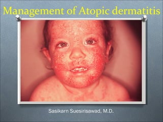 Management of Atopic dermatitis Sasikarn Suesirisawad, M.D. 