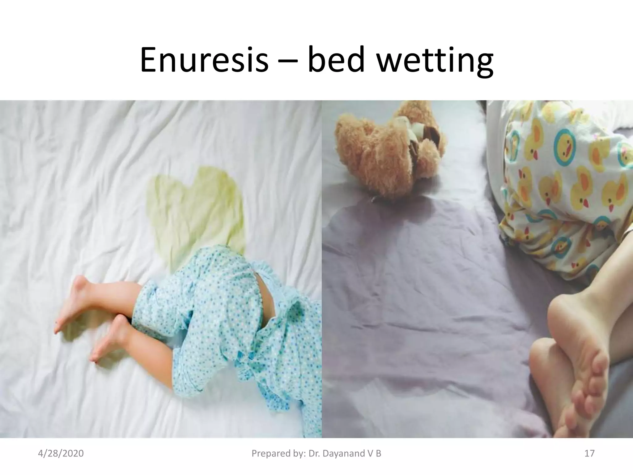 Enuresis – bed wetting
Prepared by: Dr. Dayanand V B4/28/2020 17
 