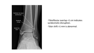 MANAGEMENT OF BIMALLEOUS FRACTURE .pptx