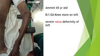 Ammini 65 yr old
B/l OA Knee more on left
severe varus deformity of
left
 