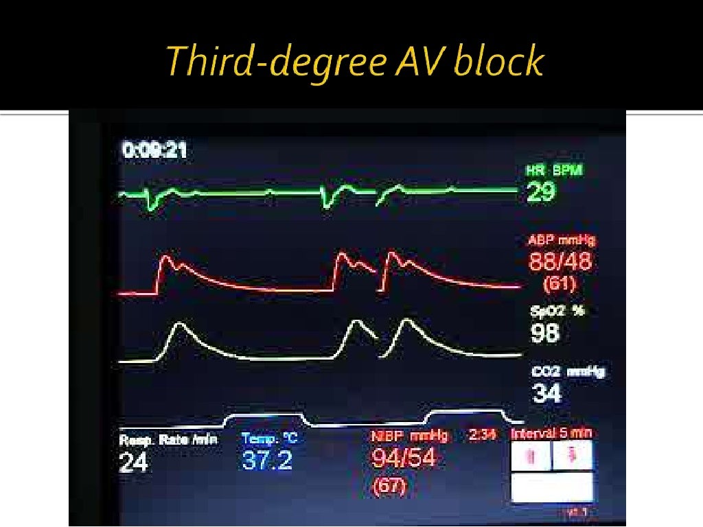 Management of bradycardia
